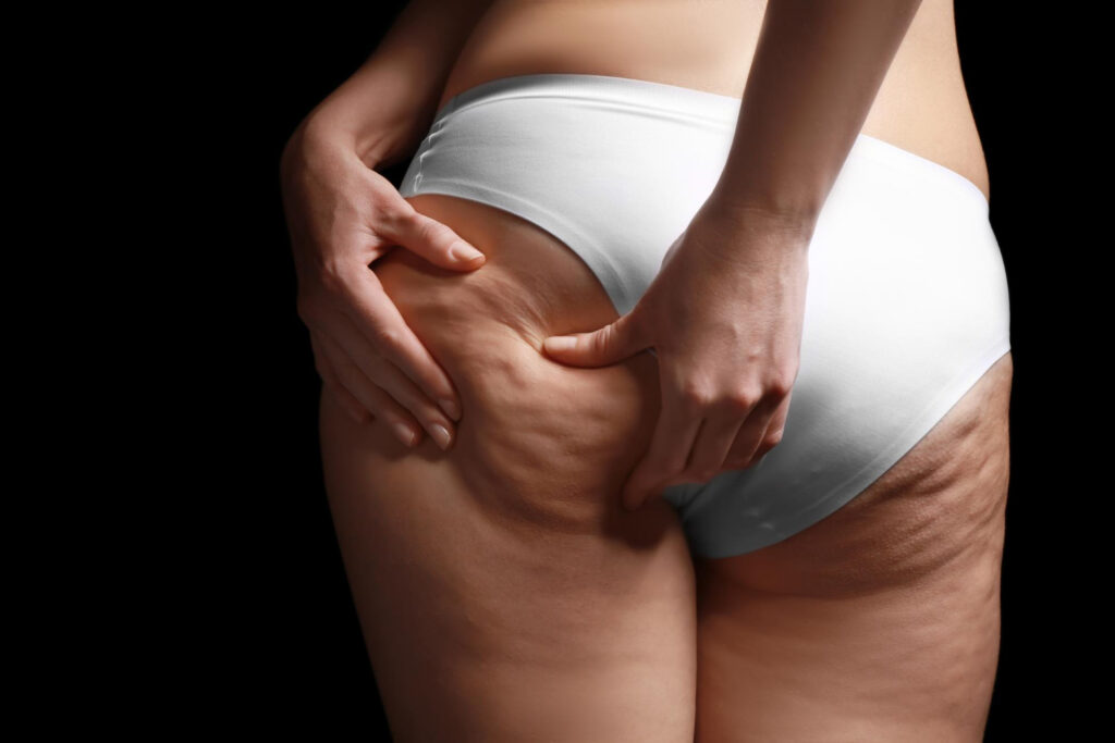 Cómo eliminar la celulitis y la retención de líquidos